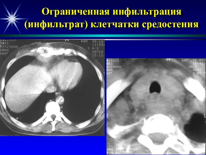 Ограниченная инфильтрация (инфильтрат) клетчатки средостения