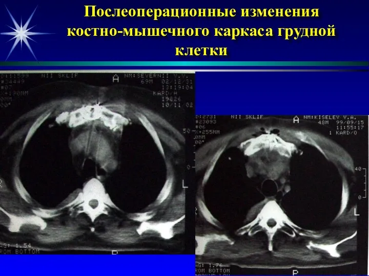 Послеоперационные изменения костно-мышечного каркаса грудной клетки