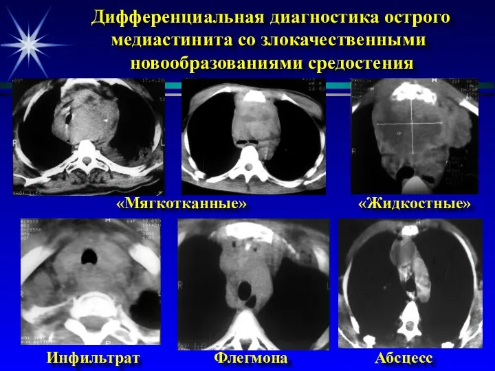 Дифференциальная диагностика острого медиастинита со злокачественными новообразованиями средостения «Мягкотканные» «Жидкостные» Инфильтрат Флегмона Абсцесс