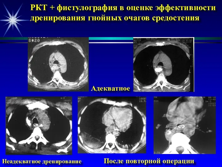 РКТ + фистулография в оценке эффективности дренирования гнойных очагов средостения Адекватное Неадекватное дренирование После повторной операции