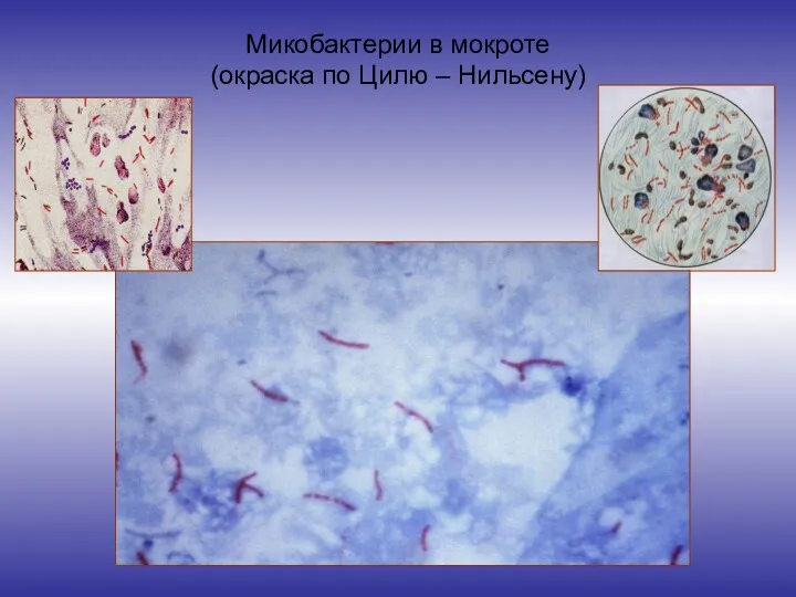 Микобактерии в мокроте (окраска по Цилю – Нильсену)