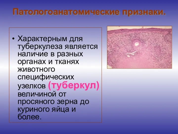 Патологоанатомические признаки. Характерным для туберкулеза является наличие в разных органах