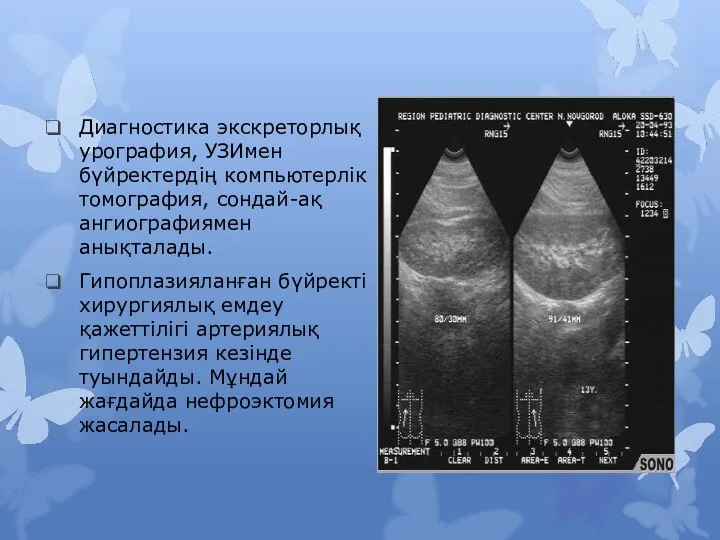 Диагностика экскреторлық урография, УЗИмен бүйректердің компьютерлік томография, сондай-ақ ангиографиямен анықталады. Гипоплазияланған бүйректі хирургиялық