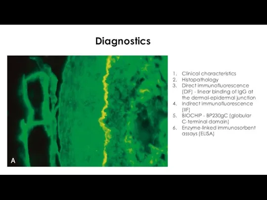 Diagnostics Clinical characteristics Histopathology Direct immunofluorescence (DIF) - linear binding of IgG at