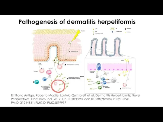 Pathogenesis of dermatitis herpetiformis Emiliano Antiga, Roberto Maglie, Lavinia Quintarelli et al. Dermatitis