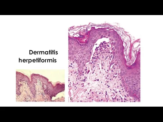 Dermatitis herpetiformis