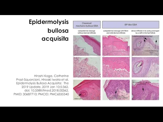 Epidermolysis bullosa acquisita Hiroshi Koga, Catherine Prost-Squarcioni, Hiroaki Iwata et al. Epidermolysis Bullosa