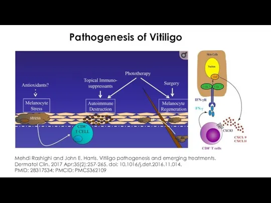 Pathogenesis of Vitiligo Mehdi Rashighi and John E. Harris. Vitiligo pathogenesis and emerging