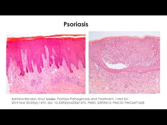 Psoriasis Adriana Rendon, Knut Schäkel. Psoriasis Pathogenesis and Treatment. J Mol Sci. 2019