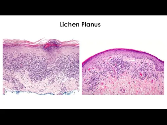 Lichen Planus