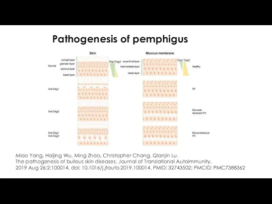 Pathogenesis of pemphigus Miao Yang, Haijing Wu, Ming Zhao, Christopher Chang, Qianjin Lu.