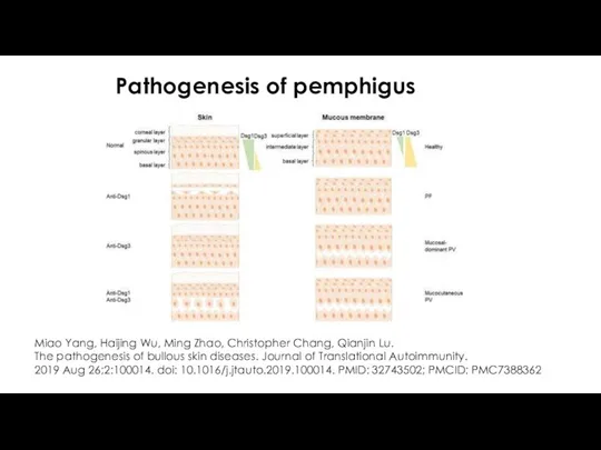 Pathogenesis of pemphigus Miao Yang, Haijing Wu, Ming Zhao, Christopher