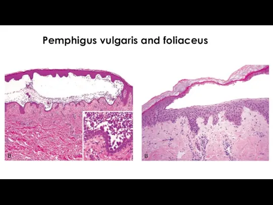 Pemphigus vulgaris and foliaceus