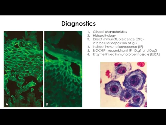 Diagnostics Clinical characteristics Histopathology Direct immunofluorescence (DIF) - intercellular deposition of IgG Indirect
