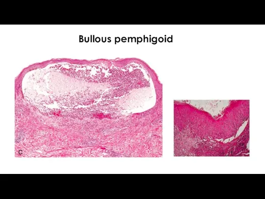 Bullous pemphigoid