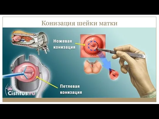 Конизация шейки матки