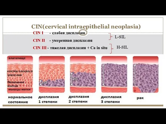 CIN(cervical intraepithelial neoplasia) CIN I - слабая дисплазия CIN II