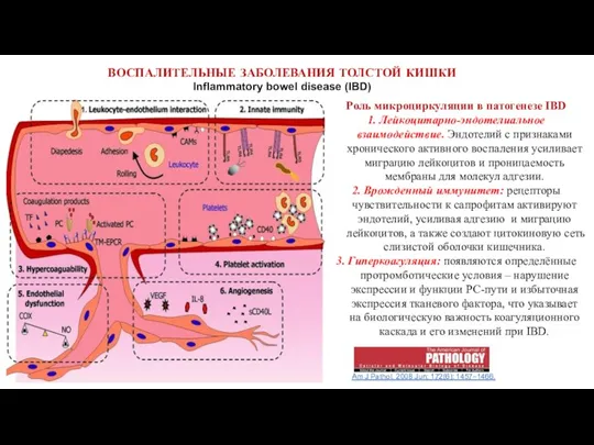 ВОСПАЛИТЕЛЬНЫЕ ЗАБОЛЕВАНИЯ ТОЛСТОЙ КИШКИ Inflammatory bowel disease (IBD) Am J Pathol. 2008 Jun;