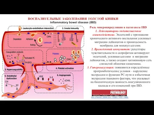 ВОСПАЛИТЕЛЬНЫЕ ЗАБОЛЕВАНИЯ ТОЛСТОЙ КИШКИ Inflammatory bowel disease (IBD) Am J