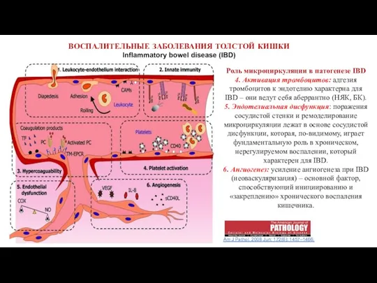 ВОСПАЛИТЕЛЬНЫЕ ЗАБОЛЕВАНИЯ ТОЛСТОЙ КИШКИ Inflammatory bowel disease (IBD) Am J Pathol. 2008 Jun;