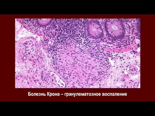 Болезнь Крона – гранулематозное воспаление