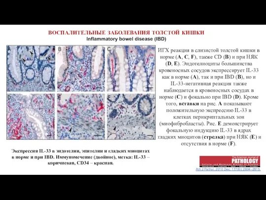 ВОСПАЛИТЕЛЬНЫЕ ЗАБОЛЕВАНИЯ ТОЛСТОЙ КИШКИ Inflammatory bowel disease (IBD) Am J Pathol. 2010 Dec;