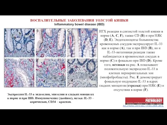 ВОСПАЛИТЕЛЬНЫЕ ЗАБОЛЕВАНИЯ ТОЛСТОЙ КИШКИ Inflammatory bowel disease (IBD) Am J