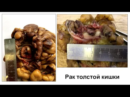 Рак толстой кишки