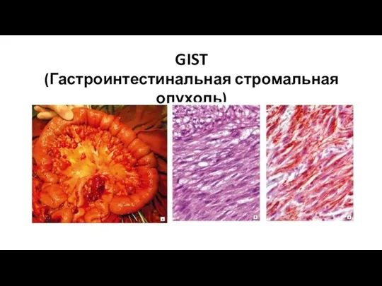 GIST (Гастроинтестинальная стромальная опухоль)