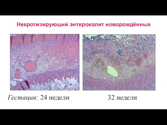 Некротизирующий энтероколит новорождённых Гестация: 24 недели 32 недели