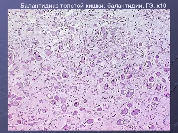 Балантидиаз толстой кишки: балантидии. ГЭ, х10