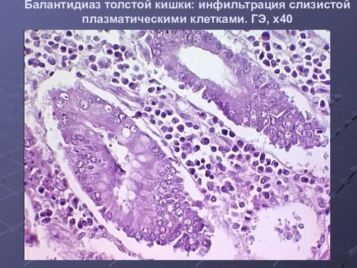 Балантидиаз толстой кишки: инфильтрация слизистой плазматическими клетками. ГЭ, х40