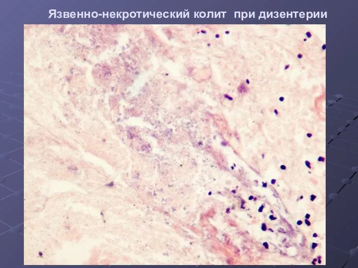 Язвенно-некротический колит при дизентерии