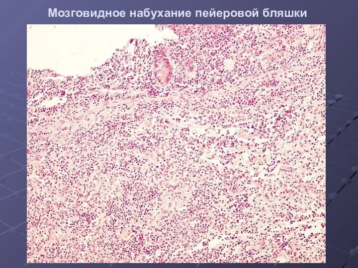 Мозговидное набухание пейеровой бляшки