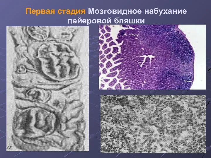 Первая стадия Мозговидное набухание пейеровой бляшки