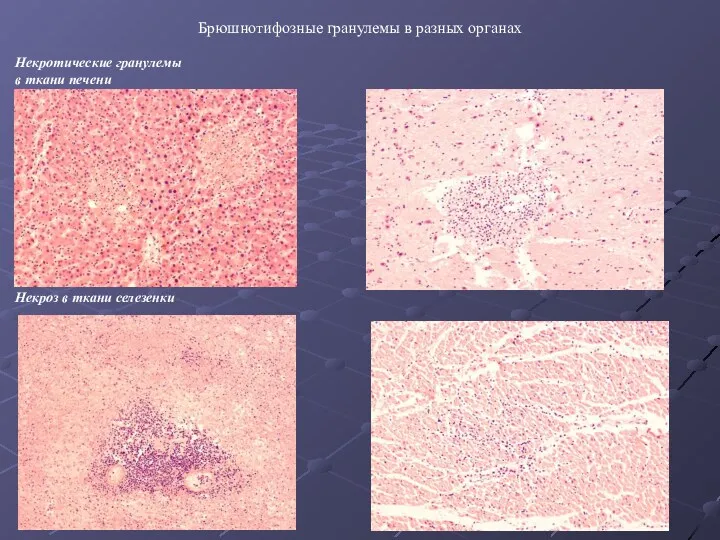 Брюшнотифозные гранулемы в разных органах Некротические гранулемы в ткани печени