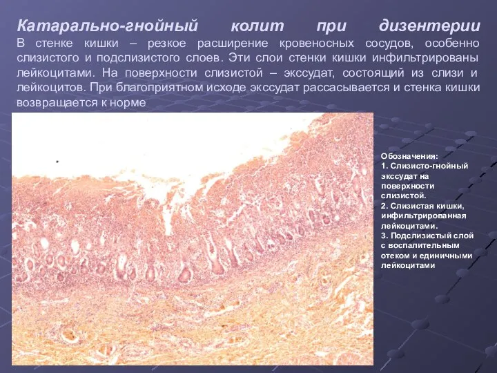 Катарально-гнойный колит при дизентерии В стенке кишки – резкое расширение