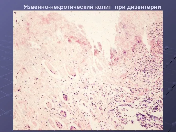 Язвенно-некротический колит при дизентерии