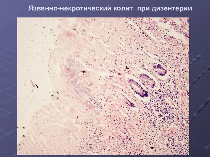 Язвенно-некротический колит при дизентерии