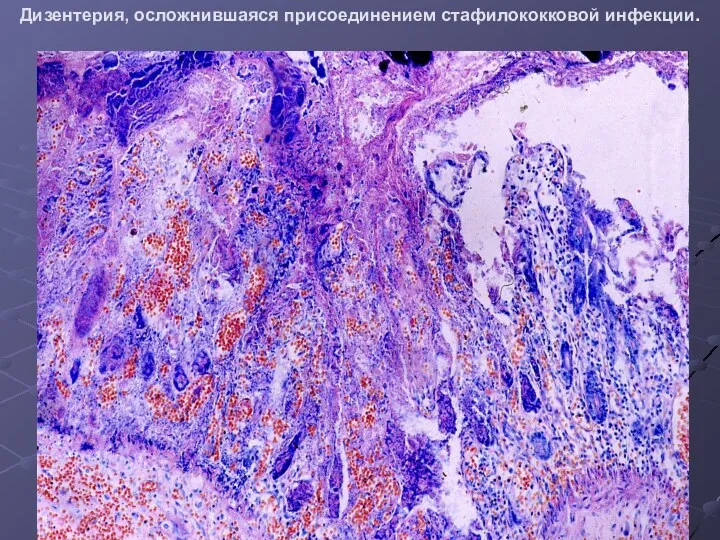 Дизентерия, осложнившаяся присоединением стафилококковой инфекции.