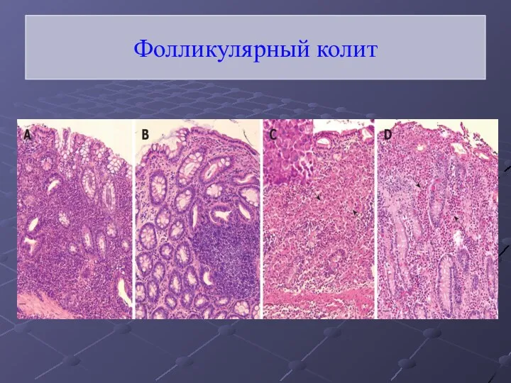 Фолликулярный колит