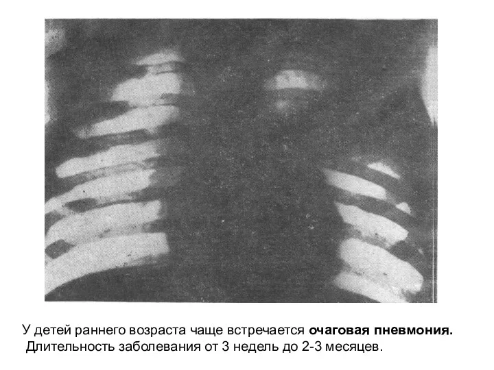 У детей раннего возраста чаще встречается очаговая пневмония. Длительность заболевания от 3 недель до 2-3 месяцев.