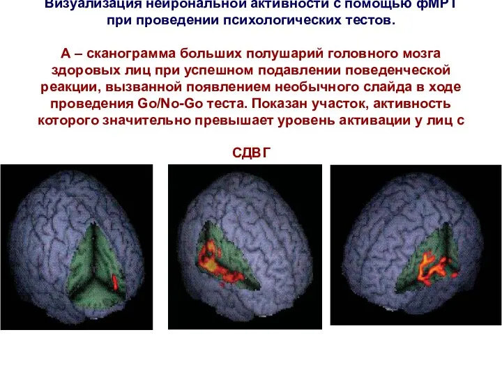 Визуализация нейрональной активности с помощью фМРТ при проведении психологических тестов. А – сканограмма