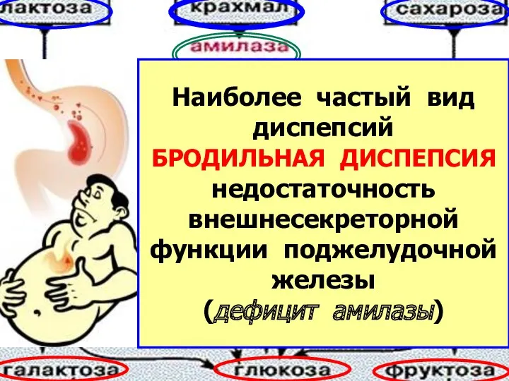 Наиболее частый вид диспепсий БРОДИЛЬНАЯ ДИСПЕПСИЯ недостаточность внешнесекреторной функции поджелудочной железы (дефицит амилазы)