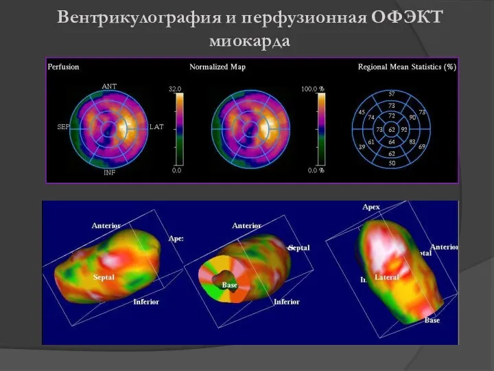 Вентрикулография и перфузионная ОФЭКТ миокарда