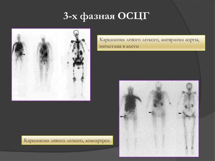 3-х фазная ОСЦГ Карцинома левого легкого, аневризма аорты, метастазы в кости Карцинома левого легкого, коксартроз