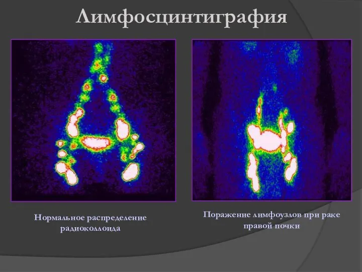 Лимфосцинтиграфия Нормальное распределение радиоколлоида Поражение лимфоузлов при раке правой почки