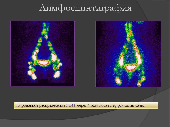 Лимфосцинтиграфия Нормальное распределение РФП через 4 года после нефрэктомии слева