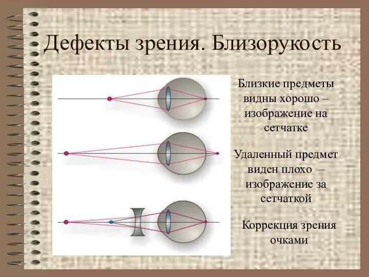 Дефекты зрения. Близорукость Близкие предметы видны хорошо – изображение на