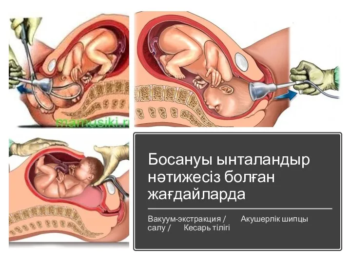 Босануы ынталандыр нәтижесіз болған жағдайларда Вакуум-экстракция / Акушерлік шипцы салу / Кесарь тілігі